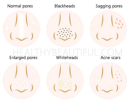 Top 5 Steps to Unclog Your Pores & Refine Your Skin - Healthy Beautiful Clogged Pores On Nose, How To Close Pores, Make Pores Smaller, Foot Detox Soak, Deep Clean Skin, Big Pores, Nose Pores, Deep Clean Pores, Smaller Pores