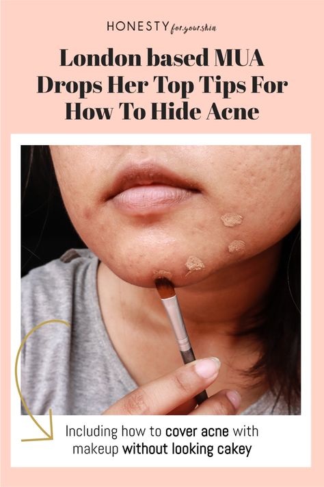 Cover Acne With Makeup, How To Cover Pimples, How To Hide Pimples, Acne With Makeup, Covering Acne With Makeup, Cover Up Pimples, Acne Scab, Acne Cover Up, Best Foundation For Acne