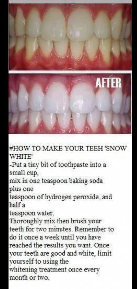 Make Teeth Whiter, Baking Soda Teeth, Natural Teeth Whitening Diy, Baking Soda Teeth Whitening, Obličejové Masky, Teeth Whitening Homemade, Baking Soda And Lemon, Teeth Whitening Remedies, Teeth Whitening Diy