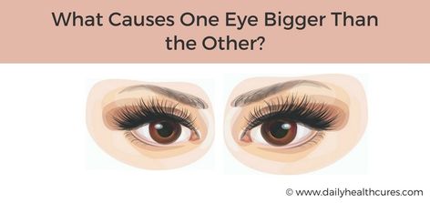 One Eye Bigger Than the Other How To Get Big Doe Eyes, One Eye Smaller Than The Other, One Eye Bigger Than The Other, Make Eyes Bigger, Uneven Eyes, Eye Twitching, Eye Bag, How To Get Bigger, Lyrics Of English Songs