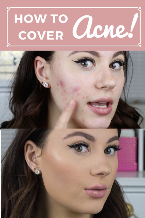 Covering Up Acne With Makeup, Makeup Hacks To Cover Acne, Best Way To Cover Acne With Makeup, Hiding Acne With Makeup, How To Conceal Acne, Make Up With Acne Skin, How To Cover Acne With Concealer, How To Cover Acne Scarring With Makeup, How To Cover Spots With Makeup