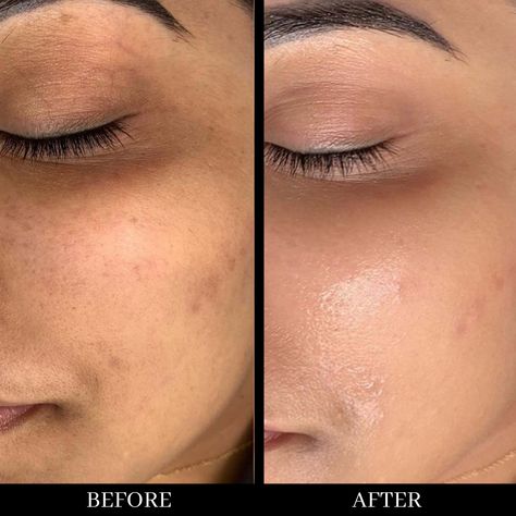 Bb Glow Before And After, Mesotherapy Before And After, Skin Before After, Skin Before And After, Before After Skincare, Before And After Skincare, Bb Glow Facial, Hydrafacial Before And After, Facial Before And After