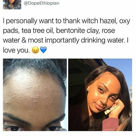 Bumps On Forehead, Bumps On Face, Small Bumps On Face, Pimples On Forehead, Forehead Acne, Natural Acne, How To Get Rid Of Pimples, Acne Remedies, How To Get Rid Of Acne