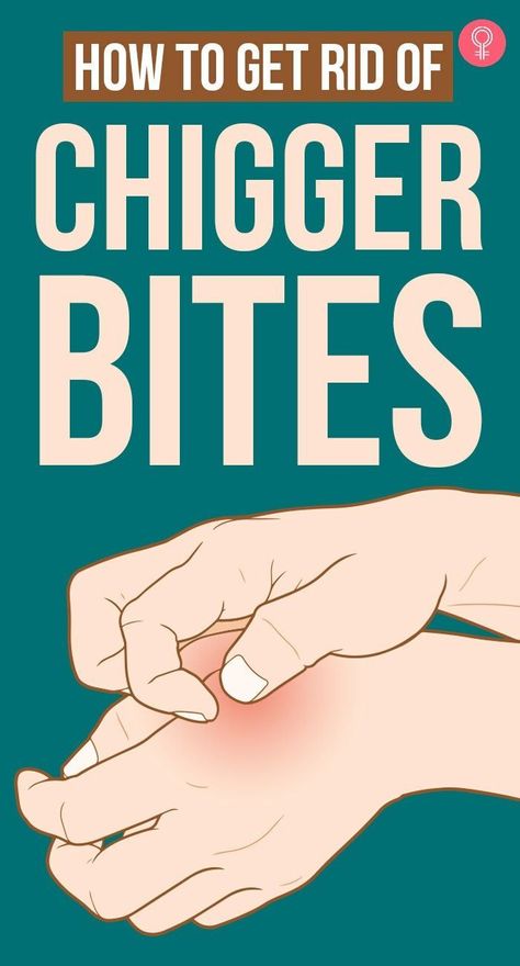 Chigger Bite Remedy, Mites On Humans, Bite Relief, Kitchen Ingredients, Natural Headache Remedies, Natural Sleep Remedies, Bug Bites, Body Pain, Homemade Remedies