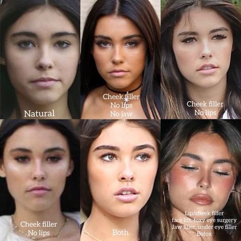 Jaw Implant Before And After, Brows And Lips Makeup, Madison Beer Plastic Surgeries, Jaw And Chin Filler, Eyebrow Botox Lift, Filler Nose Job Before After, How To Lift Your Eyes, Madison Beer Lip Fillers, Hip Filler Before And After