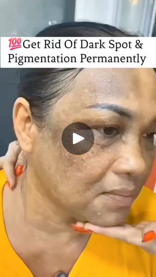 55K views · 330 reactions | Try This Effective Remedy to Reduce Pigmentation and Dark Spot. Get Spotless and Glowing Skin
#reel #darkspots #glowingskin #skinwhitening #WrinkleFreeSkin #hacks #skincare | Natural Beauty Remedy Pimple Free Skin, Top Anti Aging Products, Wrinkle Free Skin, Natural Beauty Remedies, Skincare Natural, Anti Aging Oils, Skin Lightening, Beauty Remedies, Skin Care Remedies