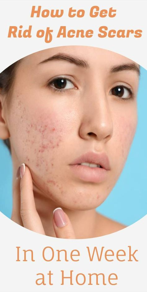 How to Get Rid of Acne Scars in One Week at Home Acne Scar Remedies, Getting Rid Of Scars, Back Acne Remedies, Scar Remedies, Acne Scaring, Acne Tips, Pimple Scars, Acne Overnight, Get Rid Of Acne