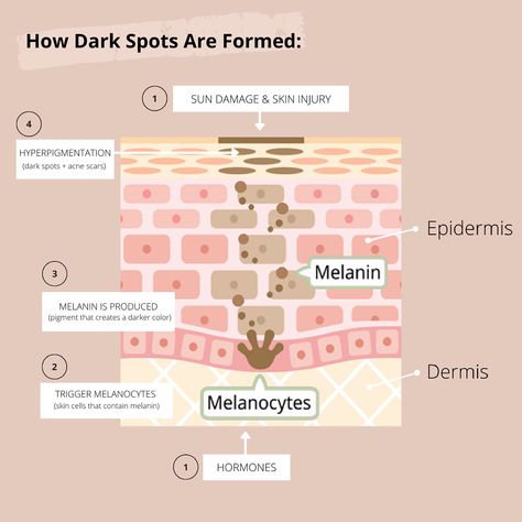 Dark spots/hyperpigmentation on the skin can happen at any time and there are a variety of factors that contribute to the formation. The most common cause is sun damage, but can also occur from overall health, stress levels, inflammation, pregnancy, or acne. We have you covered with some short & sweet edu on how dark spots are formed. New #blog up! 🧡 #skincare #skincaretips #skincareroutine #darkspotsremedies #acnescarstreatment #moisturizing #glowingskin #beautytips #beautycare #beautyblog Applying Sunscreen, Skin Anatomy, Beauty Skin Quotes, Skin Facts, Esthetician Marketing, Skin Advice, Skin Aesthetics, Sun Damaged Skin, Skin Structure