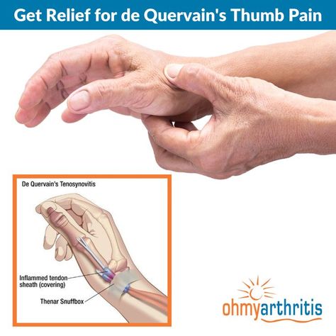 De Quervain's Tenosynovitis, or Mommy's Thumb, is a painful condition caused by inflammation and swelling in the tendons on the thumb side of the wrist and up the side of the forearm. Learn more about this condition and how it can be treated here Thumb Pain Relief, Hand Therapy Exercises, Wrist Pain Relief, Thumb Splint, K Tape, Joints Pain Remedy, Hand Health, Arthritic Pain, Wrist Pain