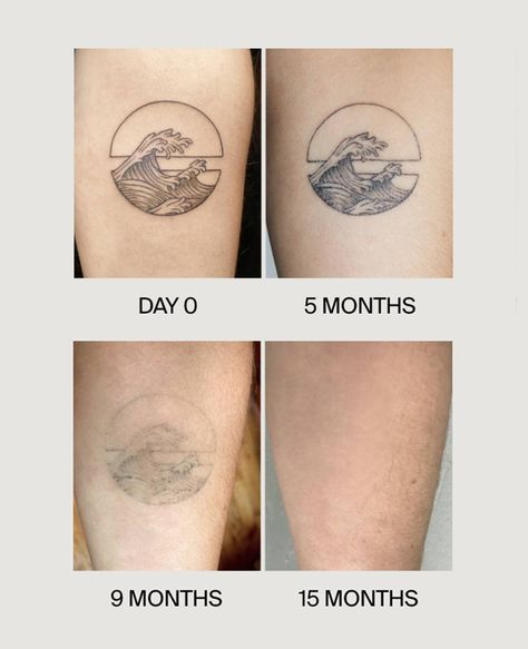 I Got a Made-to-Fade Tattoo at Ephemeral Tattoo | Who What Wear Faded Tattoos Before And After, Skin Tone Tattoo, Fading Tattoo, Fade Tattoo, Scared Of Commitment, Tattoo Peeling, Ephemeral Tattoo, Faded Tattoo, How To Fade