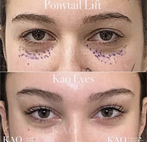 Eye Lift Surgery, Kylie Jenner Eyes, Face Plastic Surgery, Easy Cat Eye, Cat Eye Tutorial, Face Fillers, Plastic Surgery Gone Wrong, Eye Tricks, Facial Fillers