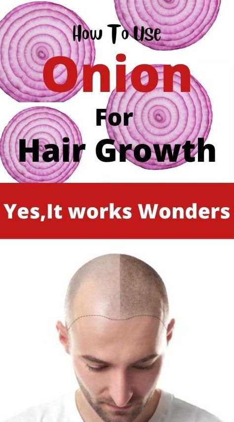 Onion Hair Growth, Hair Growth Pills, Quick Hair Growth, Accelerate Hair Growth, Healthy Natural Hair Growth, Hair Growth Foods, Onion For Hair, Hair Growth Secrets, How To Grow Your Hair Faster