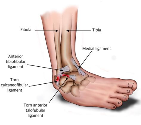 Ankle Sprain Recovery, Ankle Workout, Ankle Anatomy, Orthopedic Nurse, Ankle Strengthening Exercises, Ankle Ligaments, Ankle Injuries, Ankle Exercises, Ankle Sprain