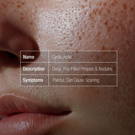 Wondering what type of acne you have? From fungal to nodular and more, we’ve simplified the different types for you. Swipe to learn about your specific acne concerns, your path to clearer skin starts here! Explore more at https://perduratherapeutics.com/ [Perdura Therapeutics, Skin science, Precision skincare, Dermatologically approved, Science driven skincare, Skin health, Acne Skincare] Skin Facts, Acne Skincare, Types Of Acne, Skin Science, Clearer Skin, Skin Care Acne, What Type, Skin Health, Different Types