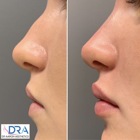 Nose Ideas, Nose Lift, Nose Fillers, Rhinoplasty Nose Jobs, Lips Inspiration, Botox Lips, Pretty Nose, Facial Fillers, Perfect Nose