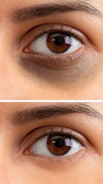 Dark Marks On Face, Cheek Acne, Marks On Face, Facial Pictures, Dark Circles Under The Eyes, Get Enough Sleep, Skin Bumps, Dark Eye Circles, Remove Dark Circles