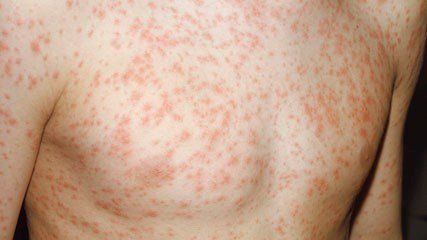 Rashes and spots in children with pictures | MadeForMums.com Page 9 Viral Rash, Skin Breaking Out, Calamine Lotion, Antifungal Cream, Itchy Rash, Sweat Gland, Viral Infection, Pregnancy Months, Study Photos