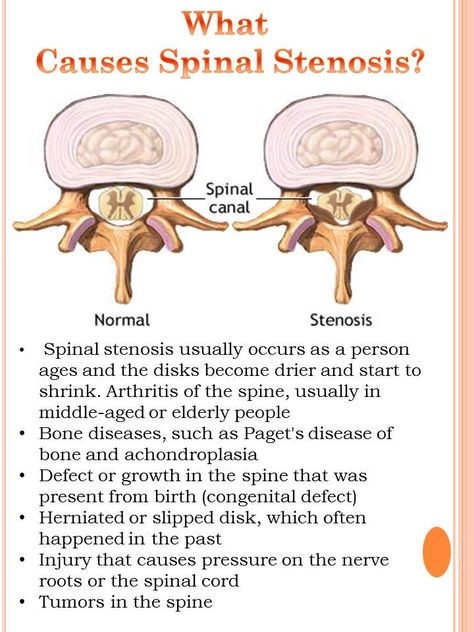 Pagets Disease, Lumbar Spine, Head Pain, Bone Diseases, Spine Health, Spine Surgery, Sciatic Nerve, Nerve Pain, Sciatica