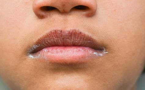 Cracked Lip Corners? You May Be Dealing With Angular Cheilitis | HUM Nutrition Blog Cracked Lip Corners, Angular Cheilitis, Hangover Headache, Sunburn Peeling, Sore Lips, Hum Nutrition, Dry Cracked Lips, Natural Face Care, B12 Deficiency