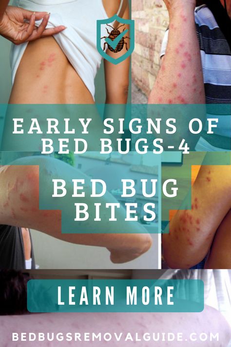 You will not notice bed bugs biting you. During the bite, a natural anesthetic is injected into your skin. It takes up to a day for the bites to become visible. Bite marks from bed bugs resemble mosquitoes, fleas, and other insects. This makes them difficult to detect at first. Several characteristics make bed bug bites unique. 👉 Learn more. Bed Bugs Bites, Bed Bug Bites Remedies, Bed Bug Bites Pictures, Bed Bug Remedies, Bed Bugs Pictures, Remedies For Mosquito Bites, Signs Of Bed Bugs, Bug Bites Remedies, Bug Bite Relief