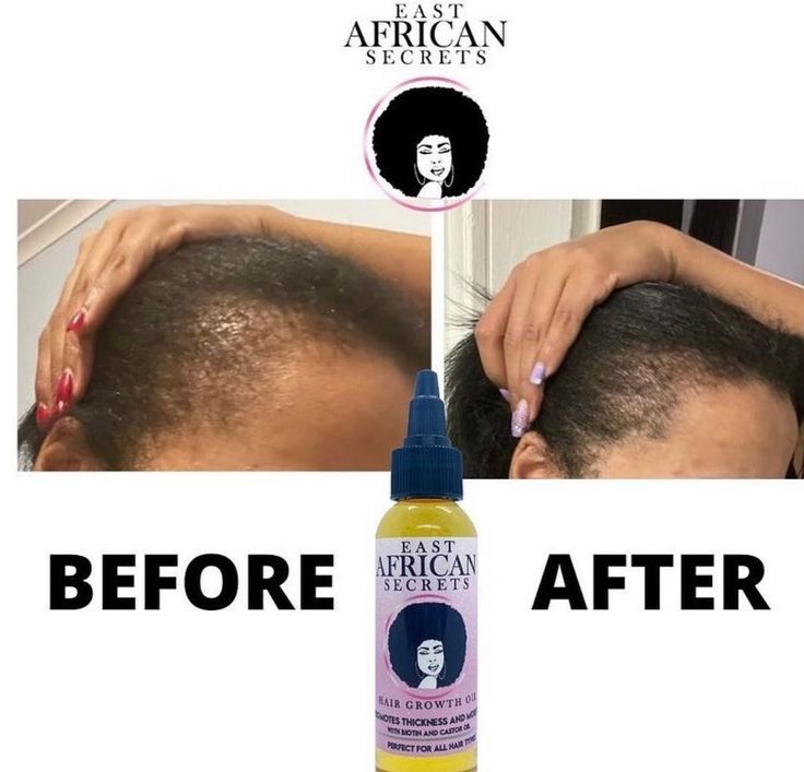 Rapid Hair Growth Oil - East African Secrets Tulsi Tea, Natural Hair Growth Oil, Rapid Hair Growth, Rosemary Sage, Hair Growth Spray, Hair Growth Secrets, Stinging Nettle, Hair Twist Styles, Hair Essentials