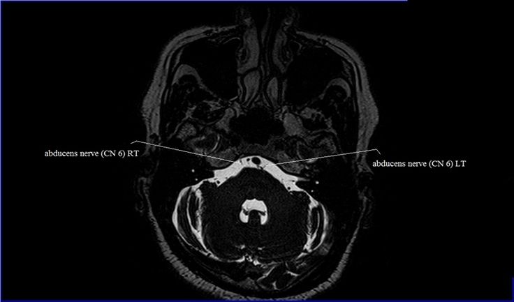 cranial nerves anatomy | MRI axial cranial nerves anatomy | free cross ...