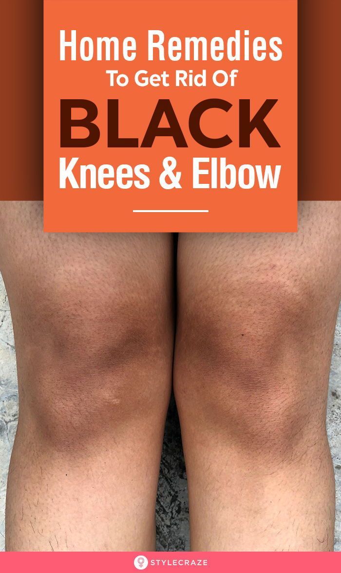 Dark Knees And Elbows, Dark Knees, Dark Elbows, Aloe Vera Face Mask, Knee Cap, Dark Underarms, Beauty Advice, Black Knees, Young And Beautiful