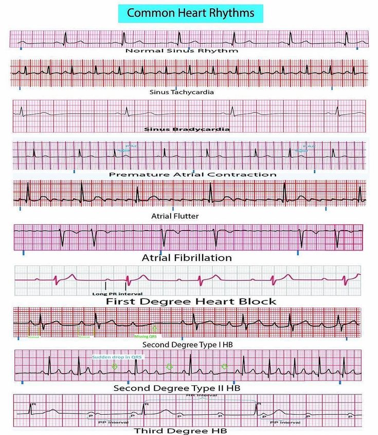 Field Reference, Ekg Nursing, Cardiothoracic Surgeon, Ekg Rhythms, Fitness Assessment, Cardiology Nursing, Ekg Interpretation, Ecg Interpretation, Cardiac Rhythms