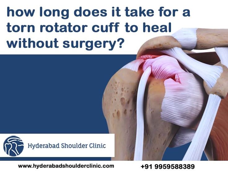 How long does it take for a torn rotator cuff to heal without surgery? Rotator Cuff Tear Exercises, Exercises For Torn Rotator Cuff, Torn Rotator Cuff Symptoms, Torn Rotator Cuff Exercises, Torn Rotator Cuff Relief, Torn Rotator Cuff Surgery, Exercises For Rotator Cuff Pain, Rotator Cuff Surgery Recovery Tips, Torn Labrum Shoulder