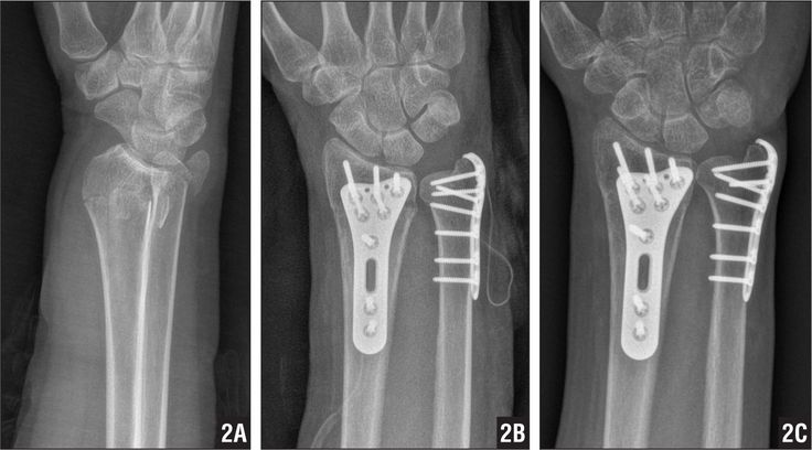 an x - ray shows the different stages of foot surgery, and how they are performed