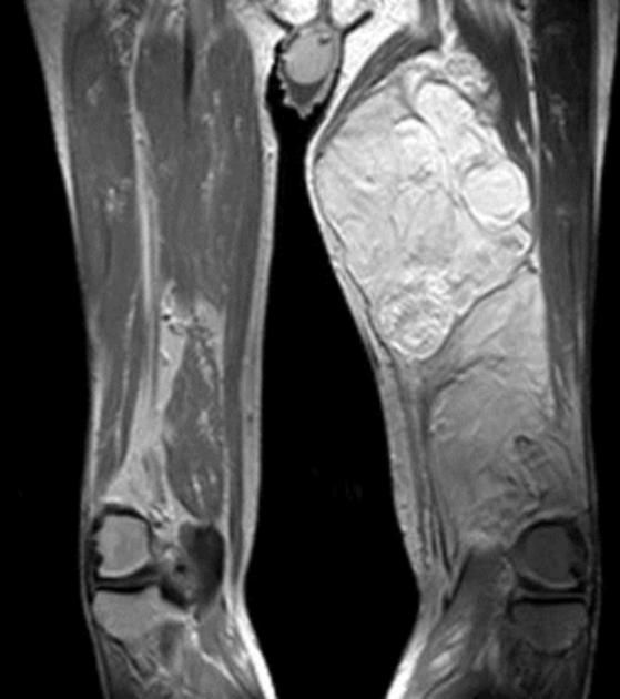 Liposarcoma of the thigh | Radiology Case | Radiopaedia.org | Radiology ...