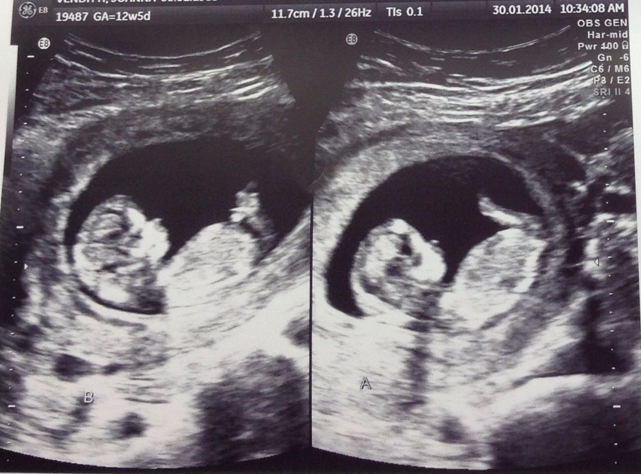 Identical Twins Ultrasound 12 Weeks