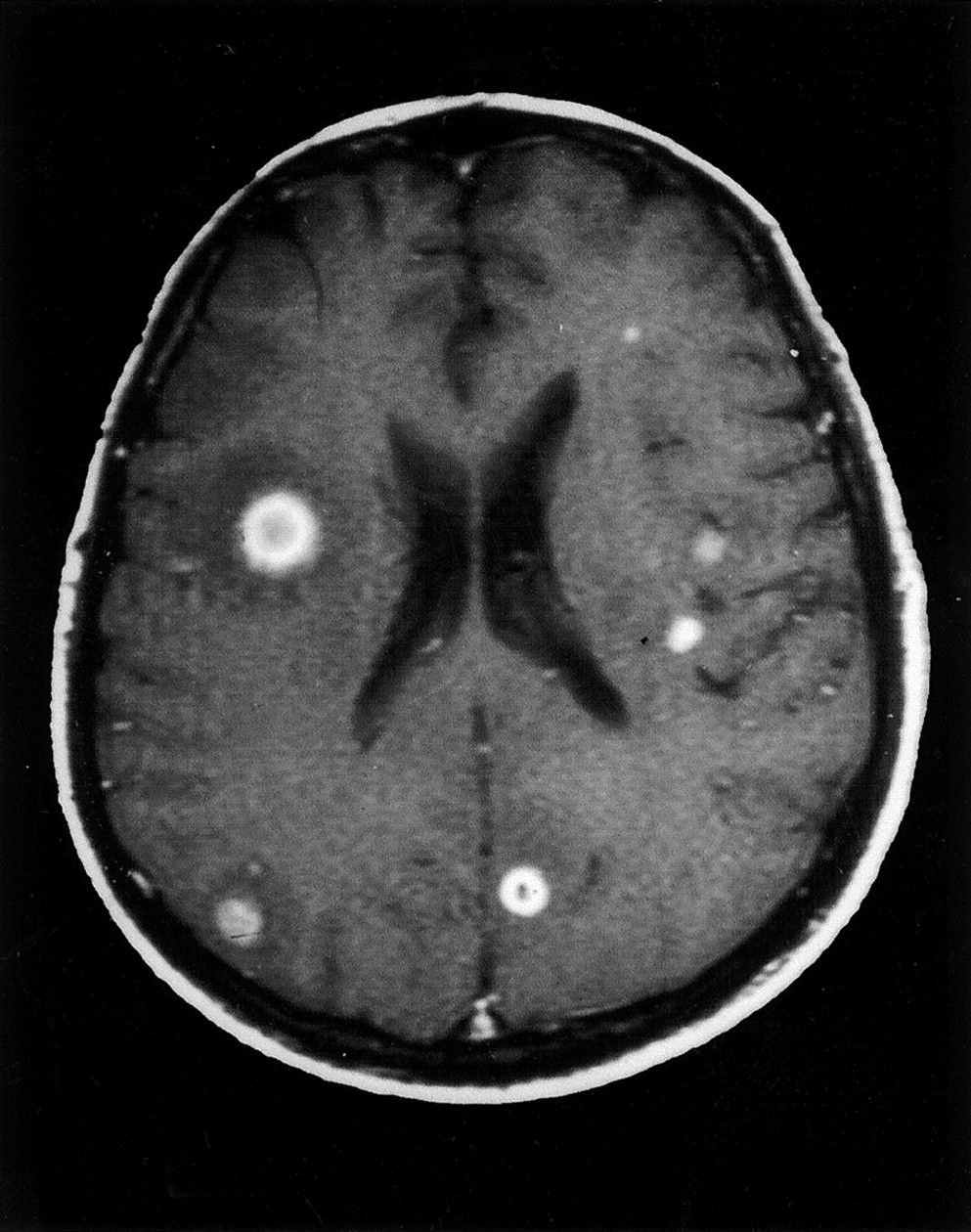 Do Brain Lesions Show On Ct Scan - BRAINLY KLW