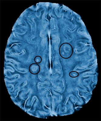 MRI imaging of brain New MRI Technique Improves Visualization of ...