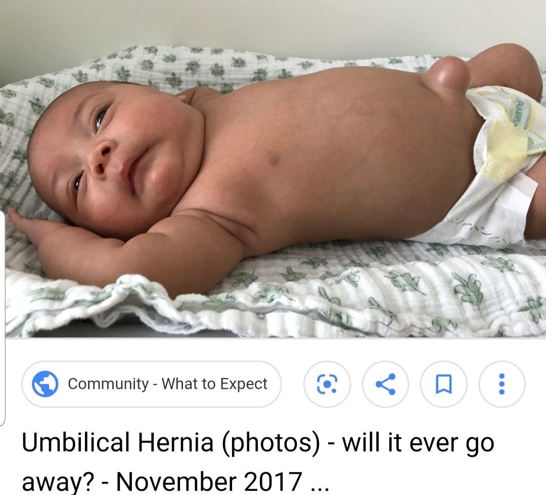 Collection 100+ Pictures umbilical hernia in infants pictures Excellent