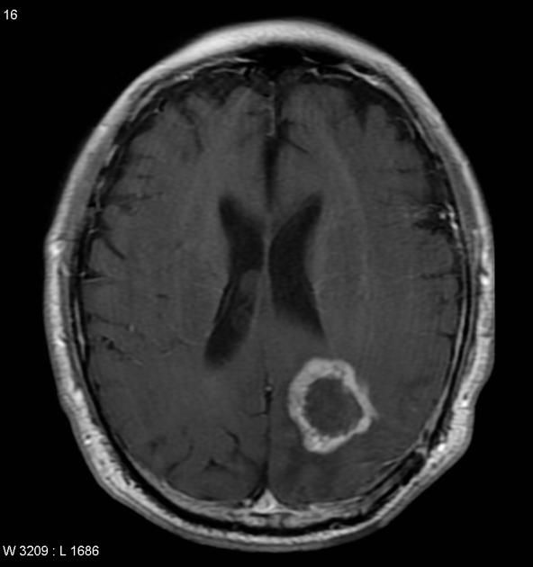 Radionecrosis - ring enhancing | Radiology Case | Radiopaedia.org in ...