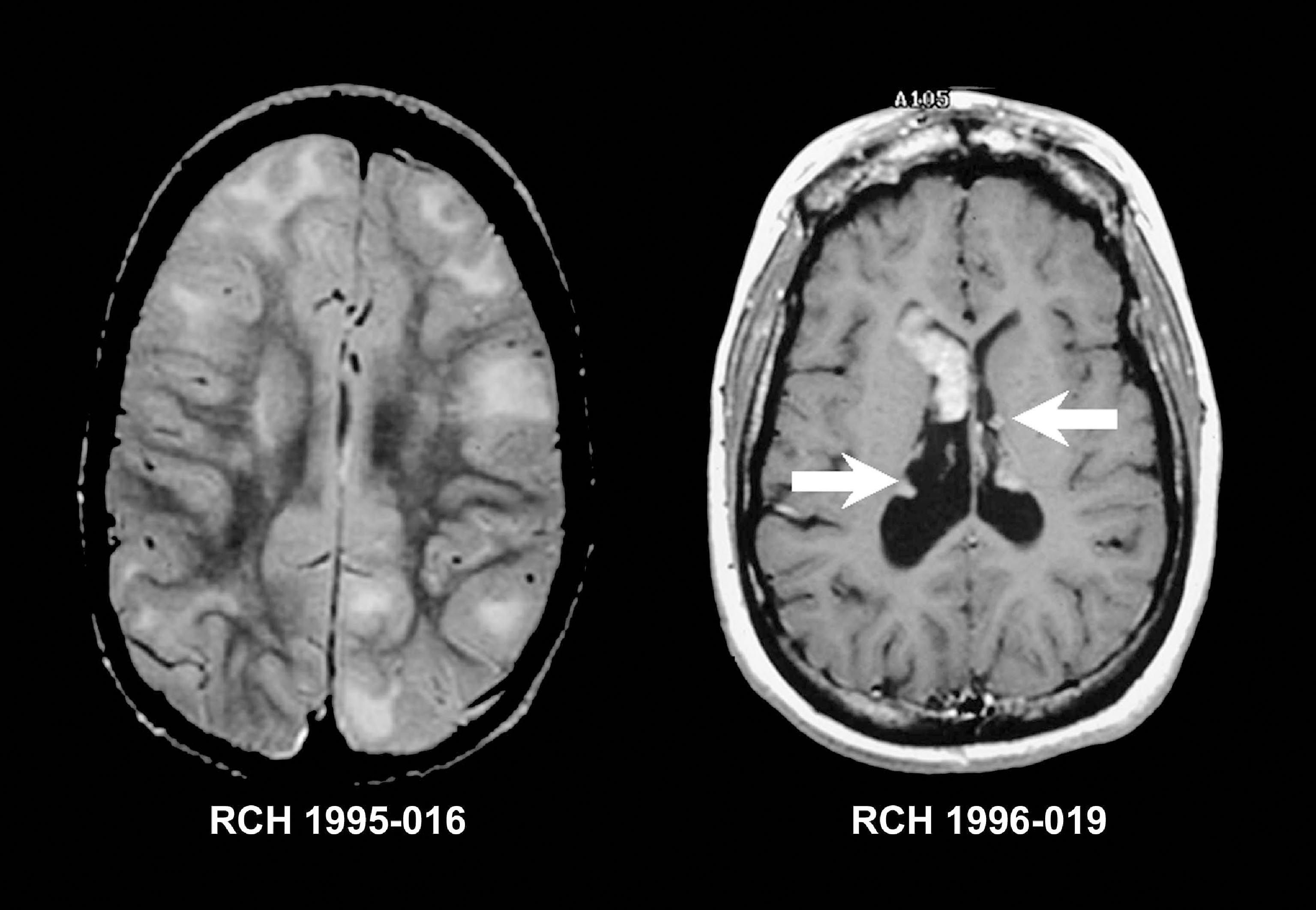 Can You Do An Mri On The Brain - BRAINLYVD