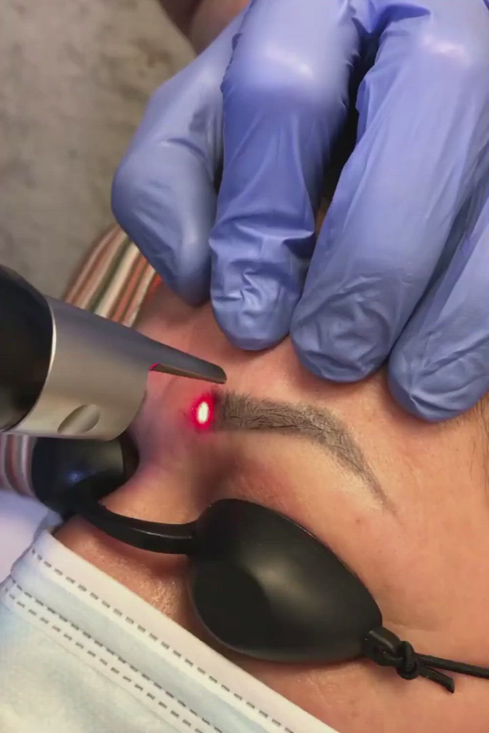 The ultrashort pulse widths used to shatter the ink and allow the tattoo to be removed are too short to permanently remove most hairs but they can stun hair growth for several months #beauty #tattoo #microblading #tattooremoval #skincare #health