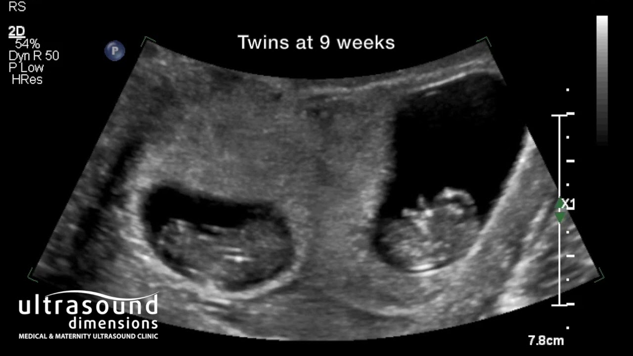 9 Weeks Pregnant Ultrasound Twins