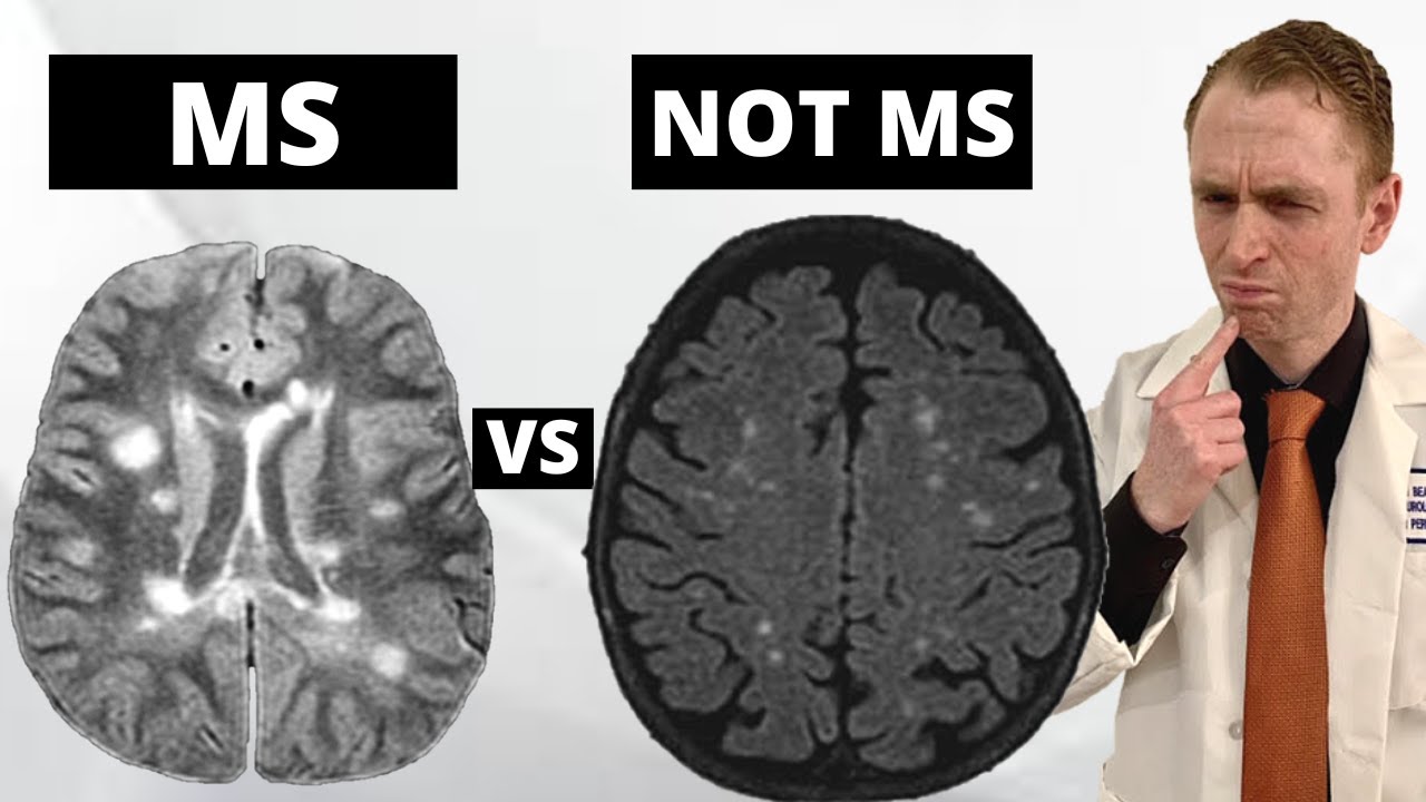 Ms Mri Lesions Vs Benign White Matter Lesions Explained By | My XXX Hot ...