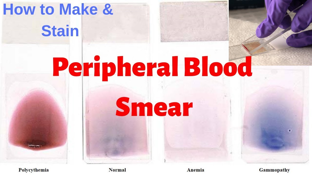 Peripheral Blood Smear Slide