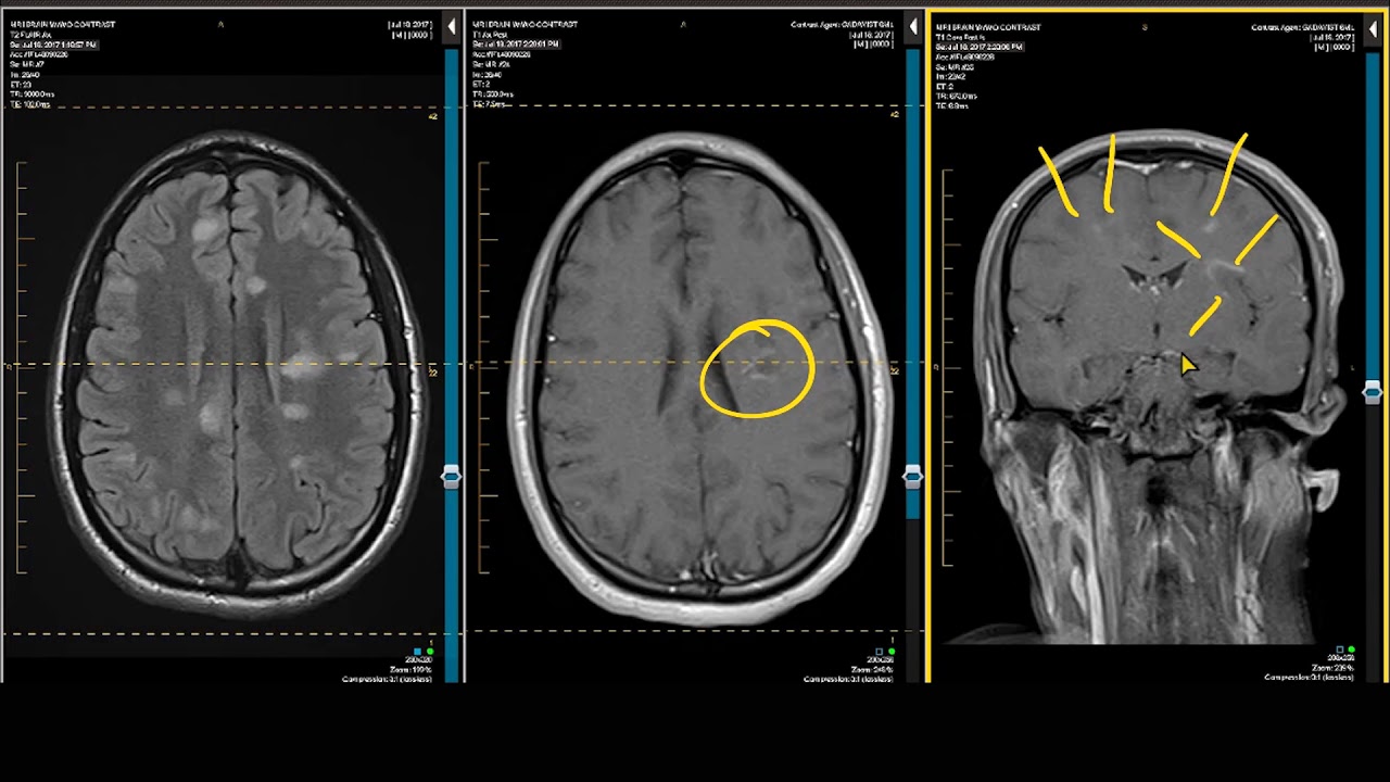 ADC Positive Multiple Sclerosis - Demyelination MRI Case Review - YouTube