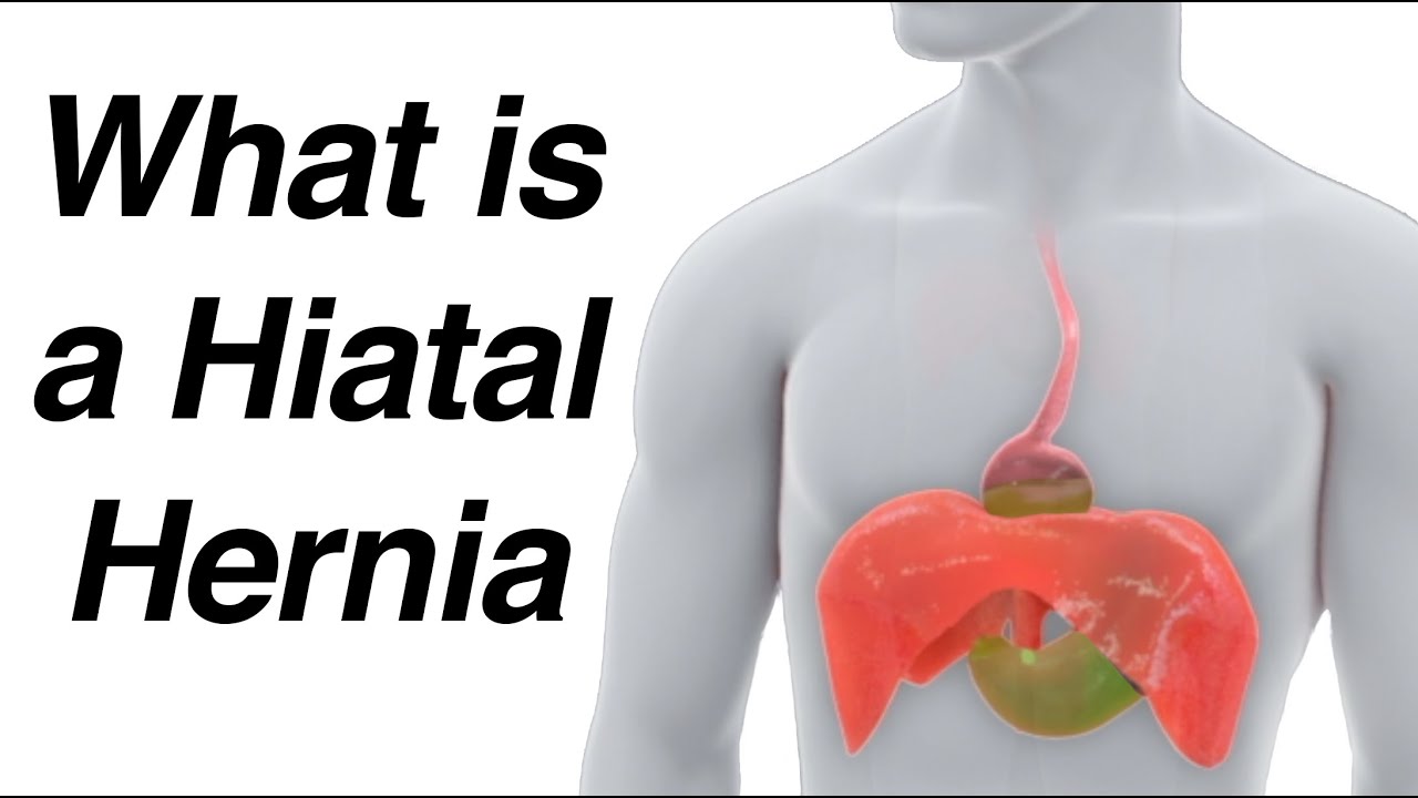 Hiatal Hernia