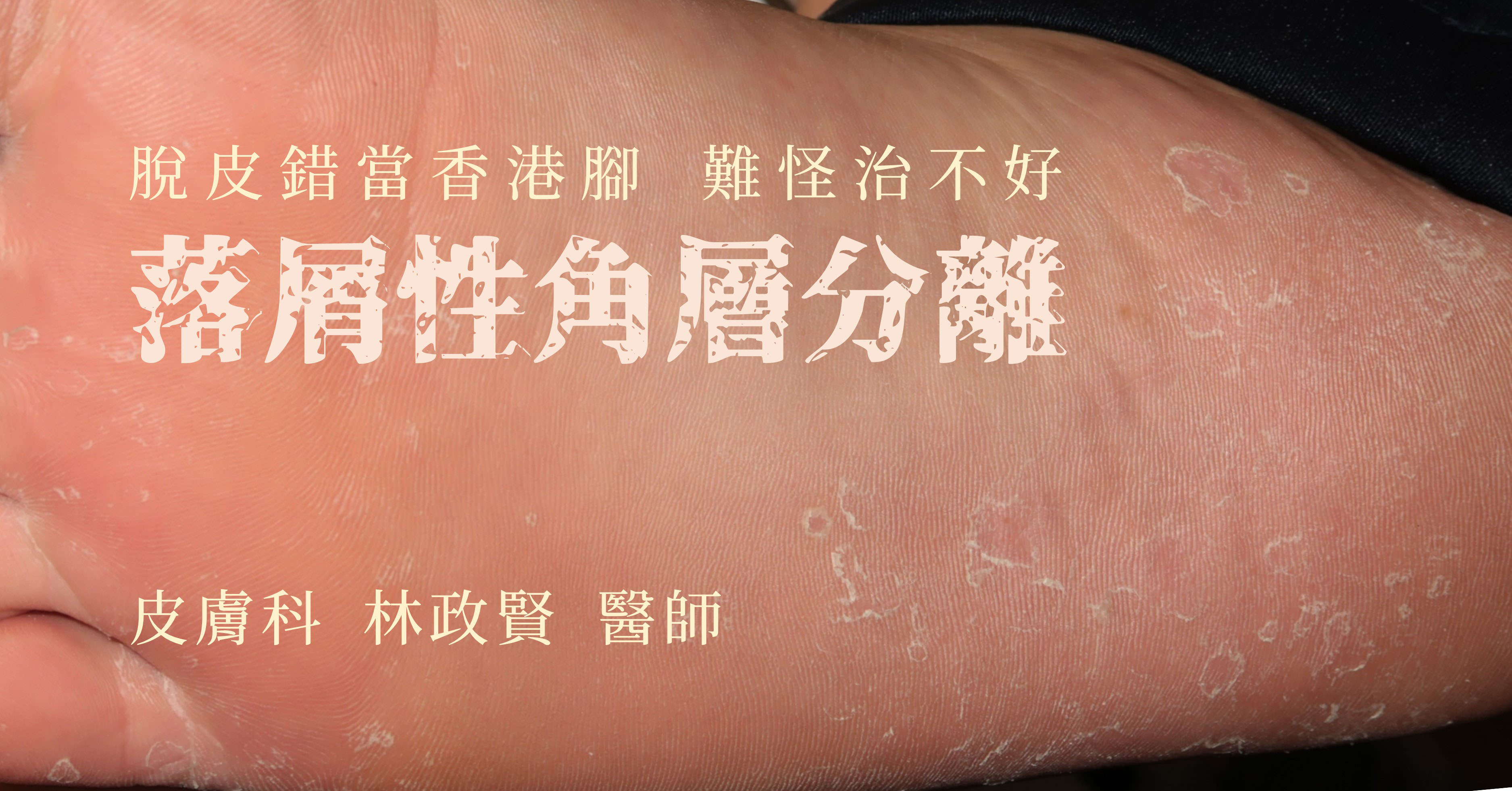 è½å±æ§è§å±¤åé¢,åè«æ§è§è³ªé¬æç,keratolysis exfoliativa,é¦æ¸¯è³,æ±ç°ç¹,æç¬