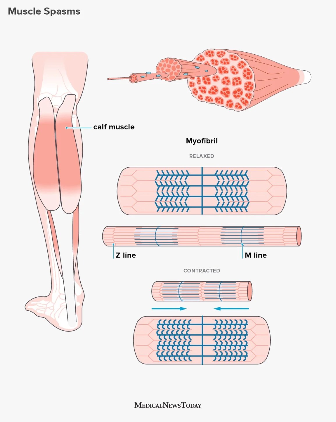 muscle-spasms