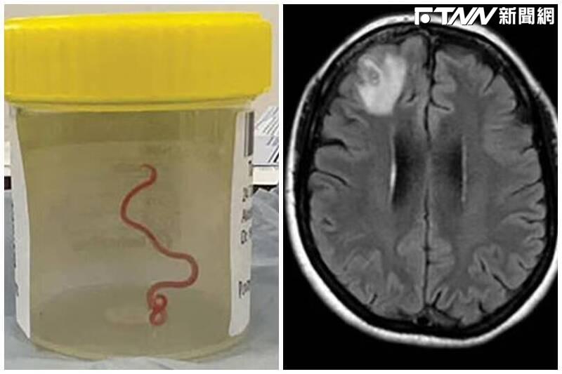 有名澳洲64歲婦女腦中藏有1條8公分蛔蟲。（圖／Canberra Health）