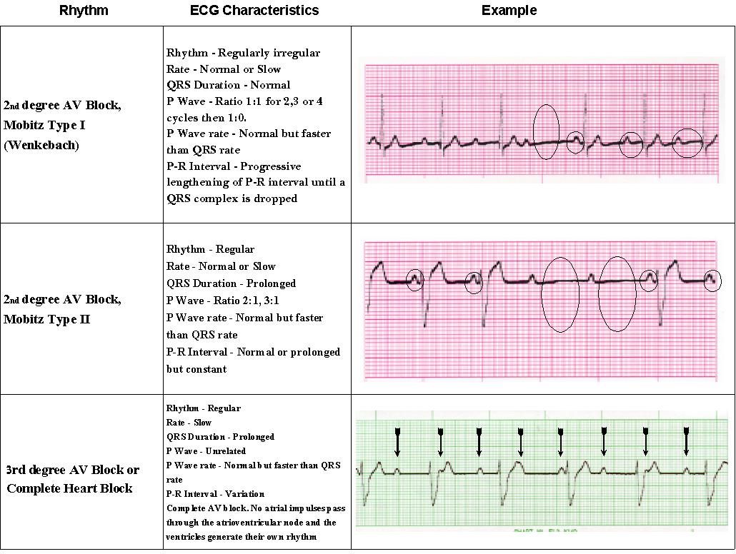 EKG Rhythms Interpretation. Best Practice Quiz Strips ACLS