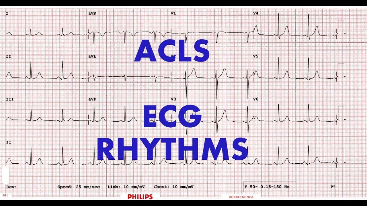 ACLS ECG Rhythm Strips Pretest Question Answers.