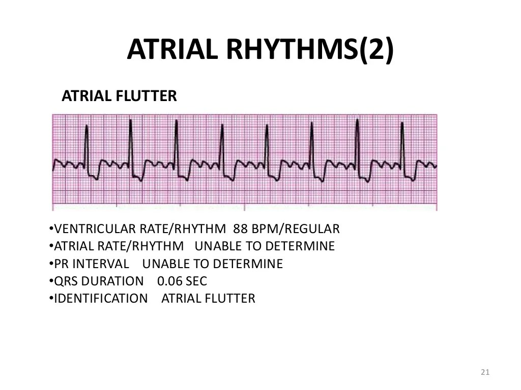 EKG Training, Practice and Quiz