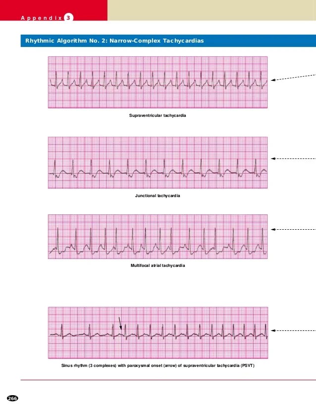 ACLS Certification ECG Rhythms Practice Test